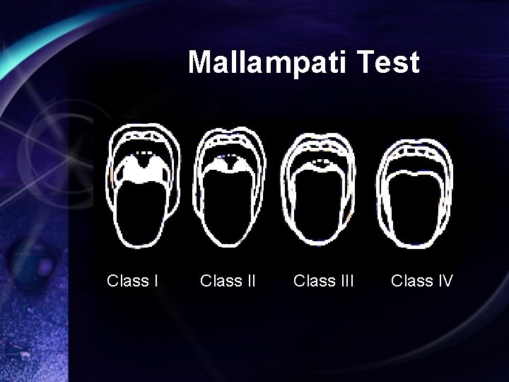 Mallampati Test Class III Class IV 