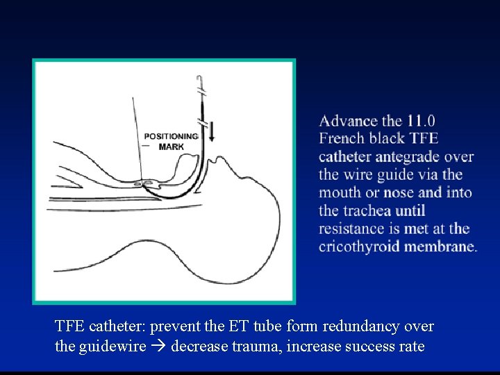 TFE catheter: prevent the ET tube form redundancy over the guidewire decrease trauma, increase