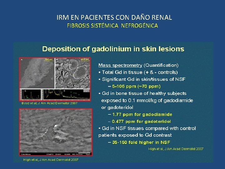 IRM EN PACIENTES CON DAÑO RENAL FIBROSIS SISTÉMICA NEFROGÉNICA 