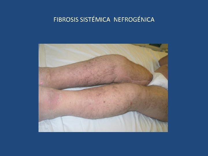 FIBROSIS SISTÉMICA NEFROGÉNICA 