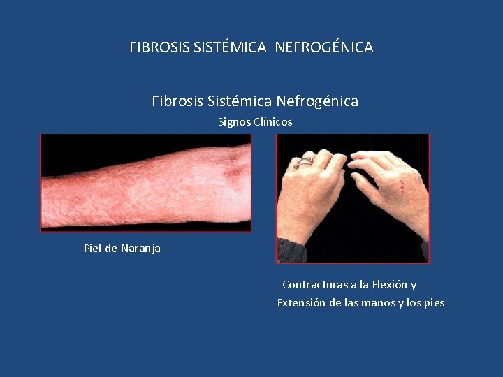 FIBROSIS SISTÉMICA NEFROGÉNICA Fibrosis Sistémica Nefrogénica Signos Clínicos Piel de Naranja Contracturas a la