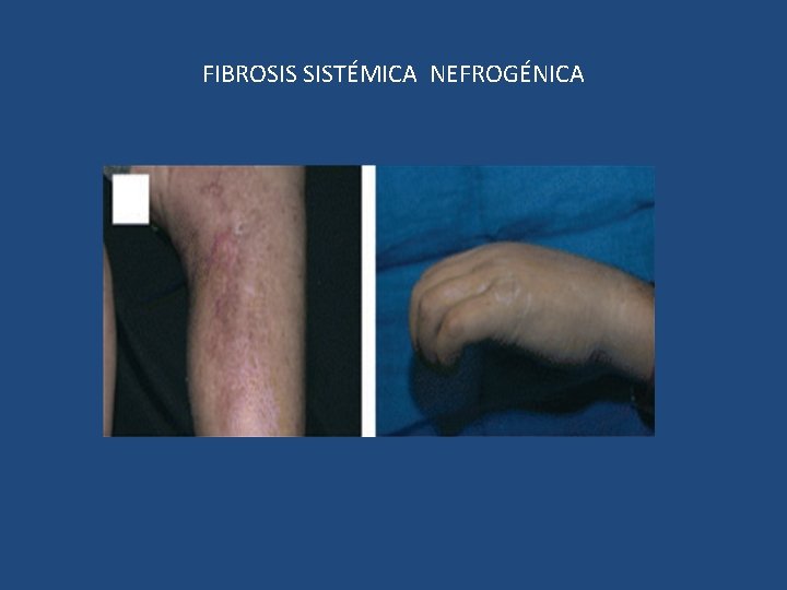 FIBROSIS SISTÉMICA NEFROGÉNICA 