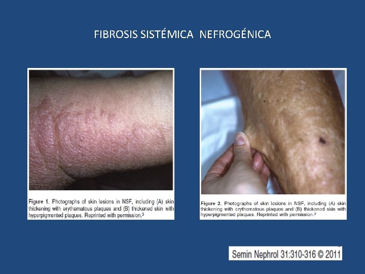 FIBROSIS SISTÉMICA NEFROGÉNICA 