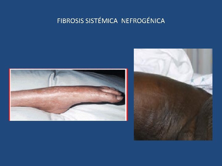 FIBROSIS SISTÉMICA NEFROGÉNICA 