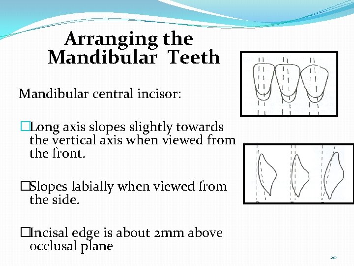 Arranging the Mandibular Teeth Mandibular central incisor: �Long axis slopes slightly towards the vertical