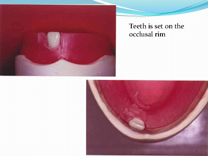 Teeth is set on the occlusal rim 5 