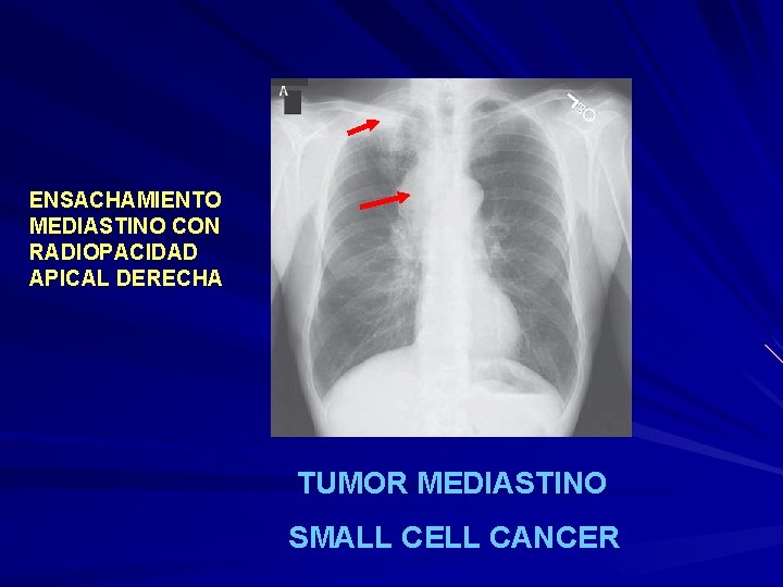 ENSACHAMIENTO MEDIASTINO CON RADIOPACIDAD APICAL DERECHA TUMOR MEDIASTINO SMALL CELL CANCER 