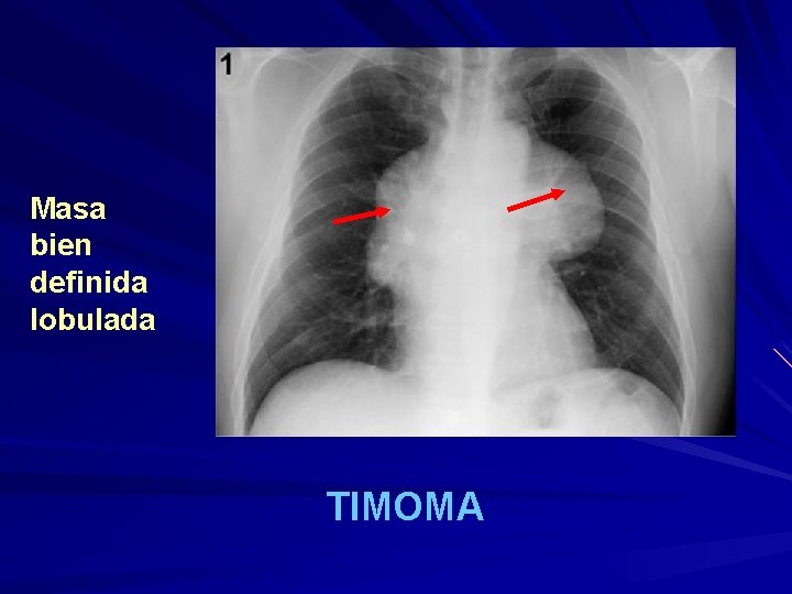 Masa bien definida lobulada TIMOMA 