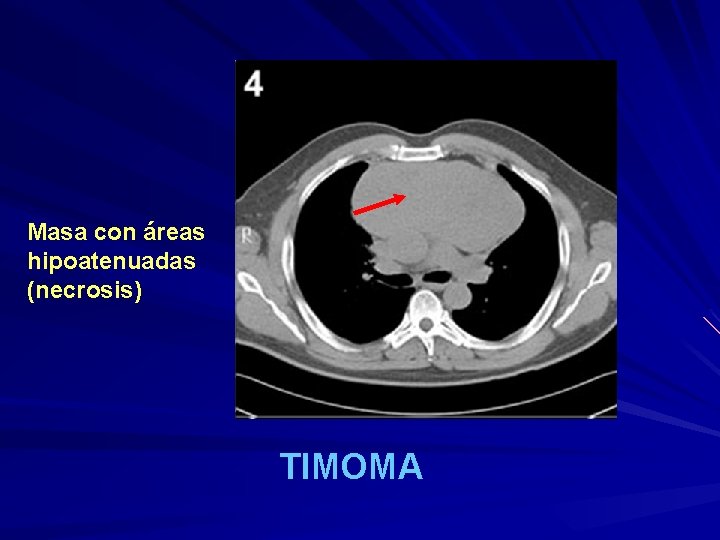 Masa con áreas hipoatenuadas (necrosis) TIMOMA 