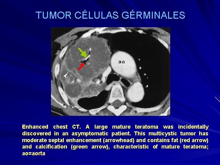 TUMOR CÉLULAS GÉRMINALES Enhanced chest CT. A large mature teratoma was incidentally discovered in