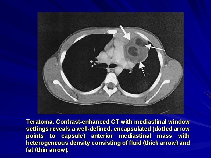 Teratoma. Contrast-enhanced CT with mediastinal window settings reveals a well-defined, encapsulated (dotted arrow points