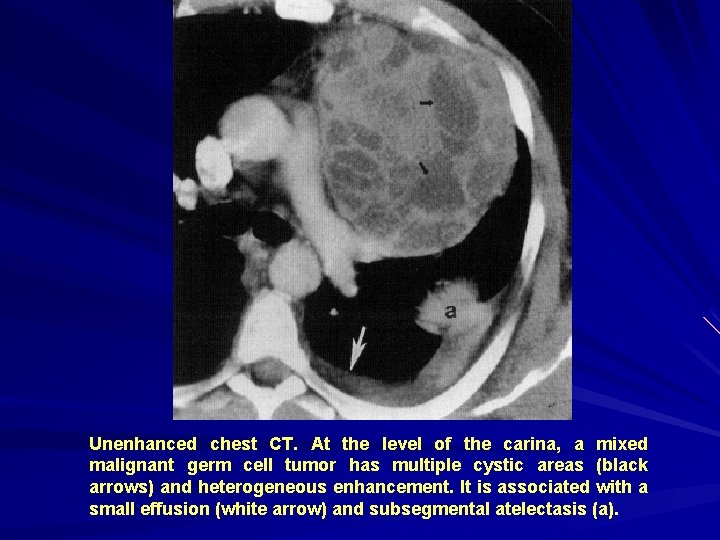 Unenhanced chest CT. At the level of the carina, a mixed malignant germ cell