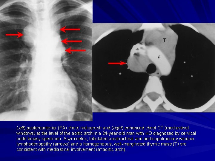 Left) posteroanterior (PA) chest radiograph and (right) enhanced chest CT (mediastinal windows) at the