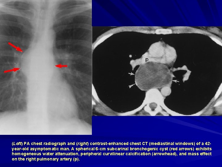 (Left) PA chest radiograph and (right) contrast-enhanced chest CT (mediastinal windows) of a 42