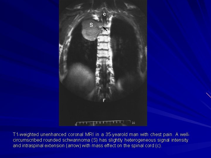 T 1 -weighted unenhanced coronal MRI in a 35 -yearold man with chest pain.