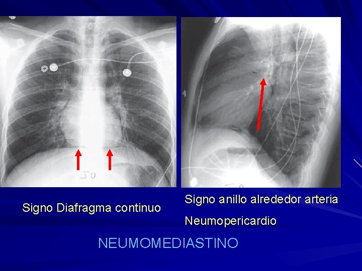 Signo Diafragma continuo Signo anillo alrededor arteria Neumopericardio NEUMOMEDIASTINO 