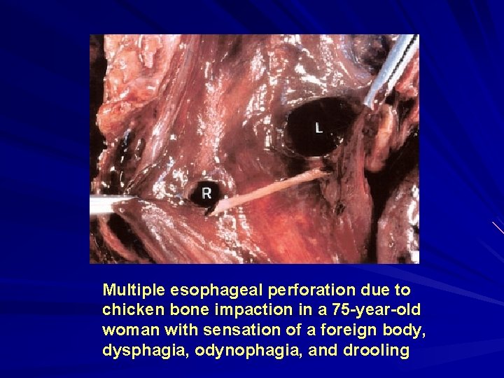 Multiple esophageal perforation due to chicken bone impaction in a 75 -year-old woman with