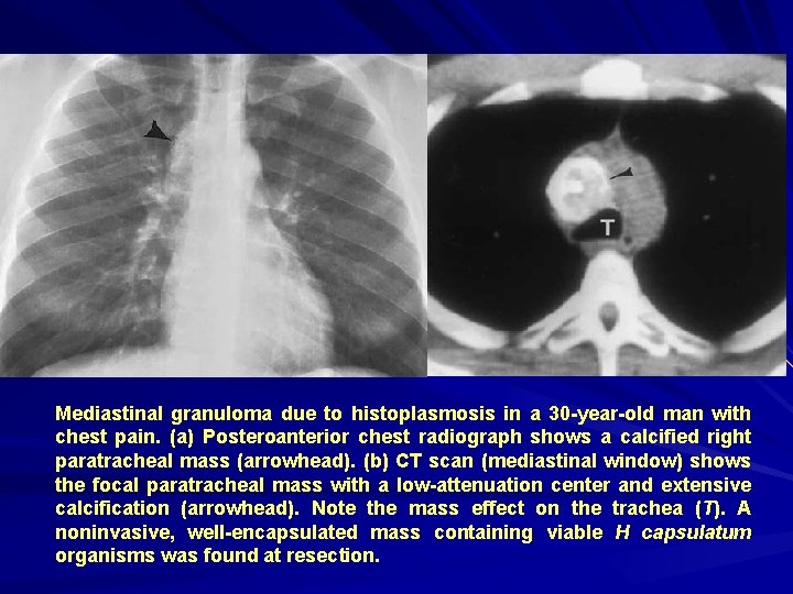 Mediastinal granuloma due to histoplasmosis in a 30 -year-old man with chest pain. (a)