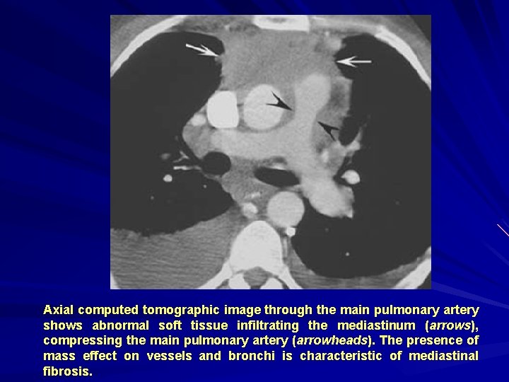 Axial computed tomographic image through the main pulmonary artery shows abnormal soft tissue infiltrating