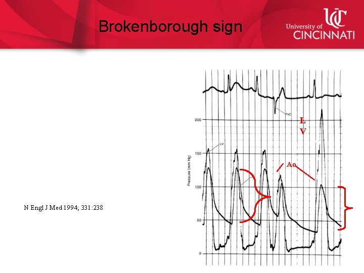 Brokenborough sign L V Ao N Engl J Med 1994; 331: 238 