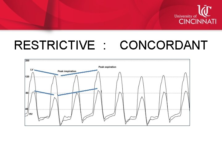 RESTRICTIVE : CONCORDANT 