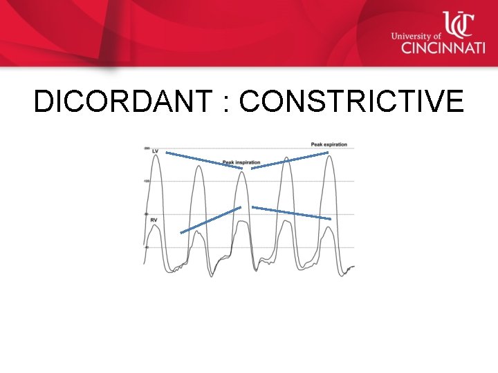 DICORDANT : CONSTRICTIVE 