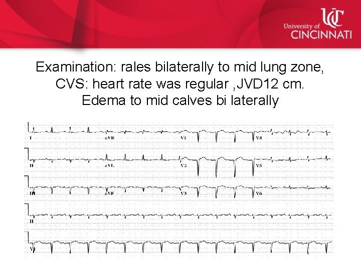 Examination: rales bilaterally to mid lung zone, CVS: heart rate was regular , JVD