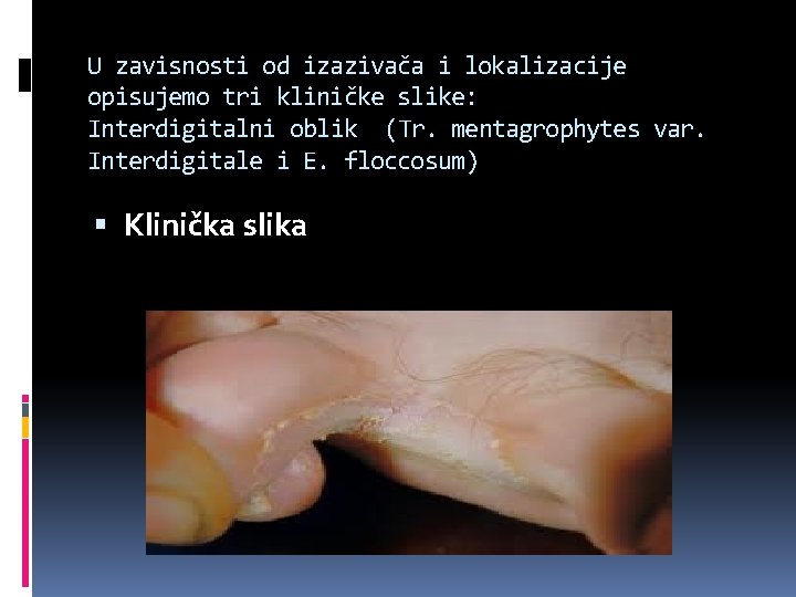 U zavisnosti od izazivača i lokalizacije opisujemo tri kliničke slike: Interdigitalni oblik (Tr. mentagrophytes