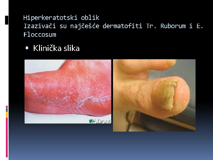 Hiperkeratotski oblik Izazivači su najčešće dermatofiti Tr. Ruborum i E. Floccosum Klinička slika 