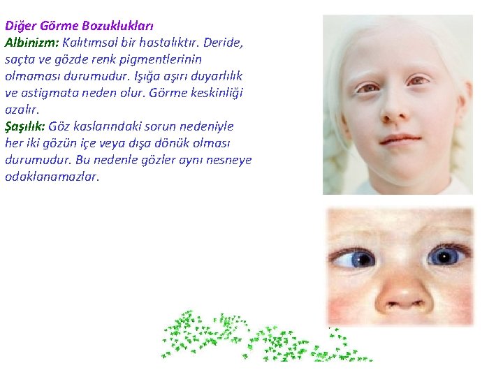 Diğer Görme Bozuklukları Albinizm: Kalıtımsal bir hastalıktır. Deride, saçta ve gözde renk pigmentlerinin olmaması