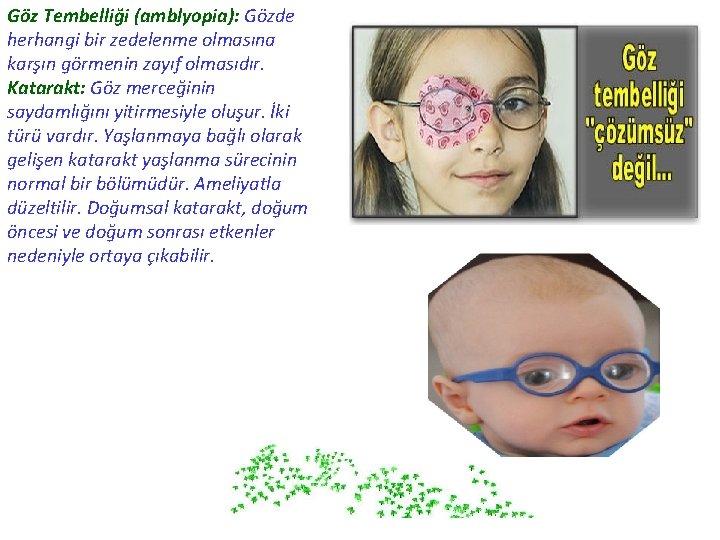 Göz Tembelliği (amblyopia): Gözde herhangi bir zedelenme olmasına karşın görmenin zayıf olmasıdır. Katarakt: Göz