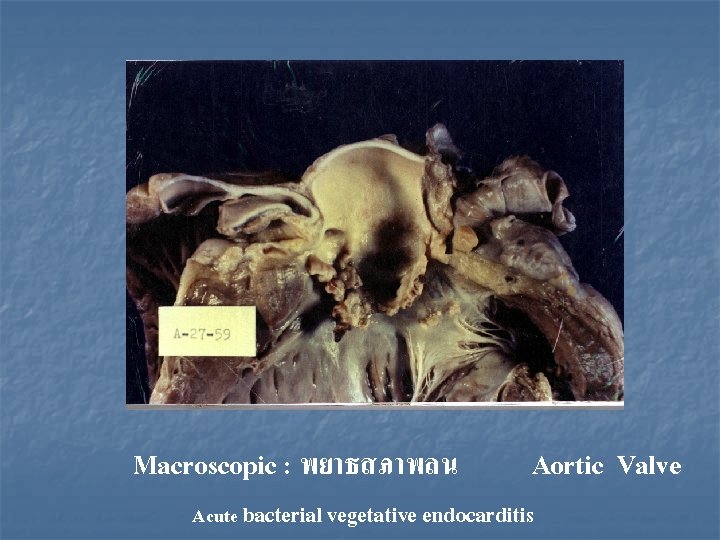 Macroscopic : พยาธสภาพลน Aortic Valve Acute bacterial vegetative endocarditis 
