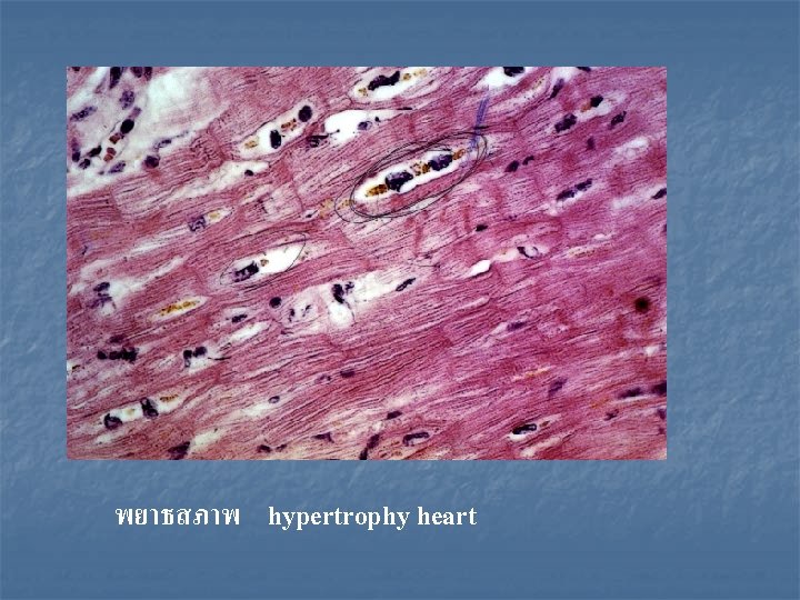 พยาธสภาพ hypertrophy heart 