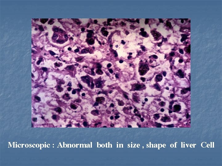 Microscopic : Abnormal both in size , shape of liver Cell 