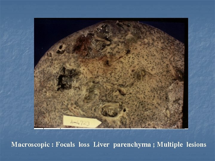 Macroscopic : Focals loss Liver parenchyma ; Multiple lesions 