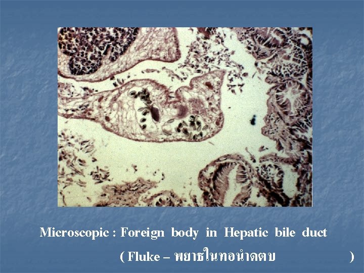 Microscopic : Foreign body in Hepatic bile duct ( Fluke – พยาธในทอนำดตบ ) 