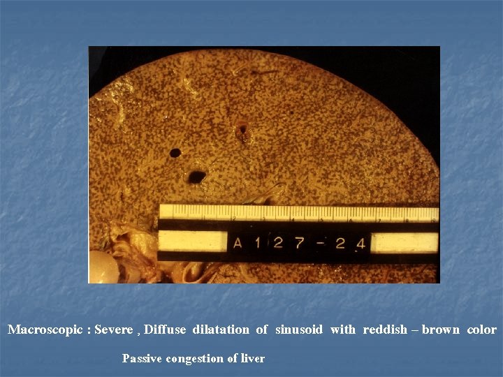 Macroscopic : Severe , Diffuse dilatation of sinusoid with reddish – brown color Passive