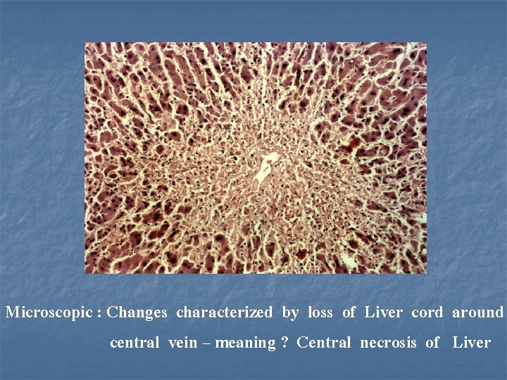 Microscopic : Changes characterized by loss of Liver cord around central vein – meaning