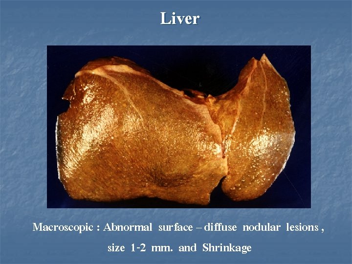 Liver Macroscopic : Abnormal surface – diffuse nodular lesions , size 1 -2 mm.