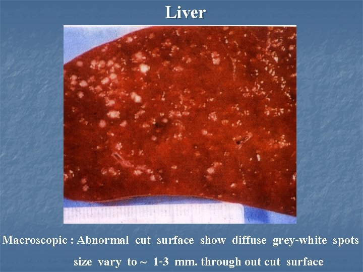 Liver Macroscopic : Abnormal cut surface show diffuse grey-white spots size vary to ~