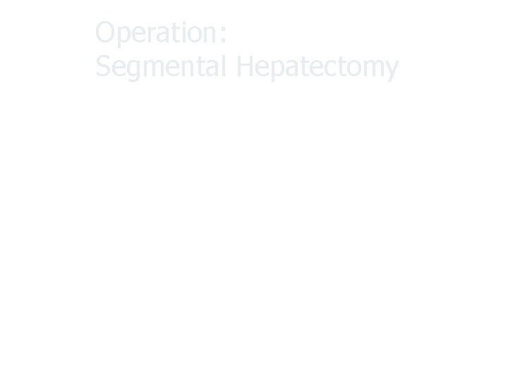 Operation: Segmental Hepatectomy 1. ETGA, supine position 2. Subcostal incision at right side, with
