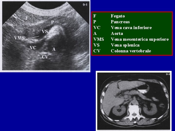 F P VC A VMS VS CV Fegato Pancreas Vena cava inferiore Aorta Vena F P VC A VMS VS CV Fegato Pancreas Vena cava inferiore Aorta Vena