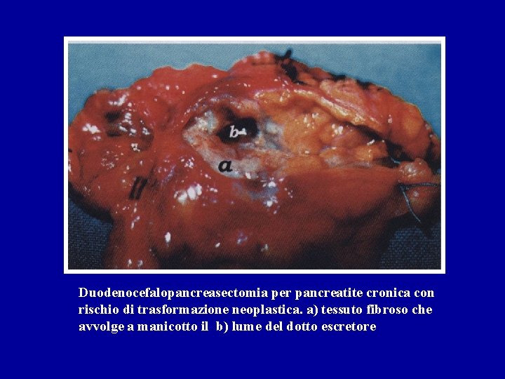 Duodenocefalopancreasectomia per pancreatite cronica con rischio di trasformazione neoplastica. a) tessuto fibroso che avvolge Duodenocefalopancreasectomia per pancreatite cronica con rischio di trasformazione neoplastica. a) tessuto fibroso che avvolge