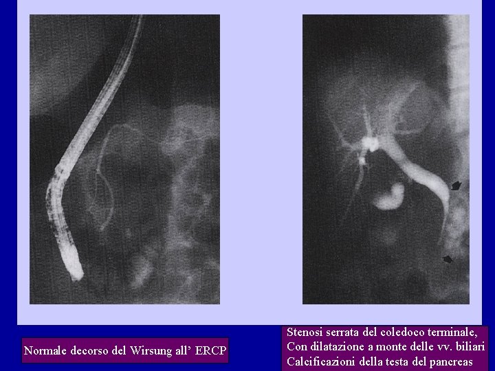 Normale decorso del Wirsung all’ ERCP Stenosi serrata del coledoco terminale, Con dilatazione a Normale decorso del Wirsung all’ ERCP Stenosi serrata del coledoco terminale, Con dilatazione a