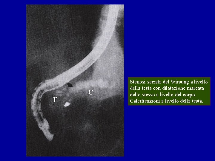 T C Stenosi serrata del Wirsung a livello della testa con dilatazione marcata dello T C Stenosi serrata del Wirsung a livello della testa con dilatazione marcata dello