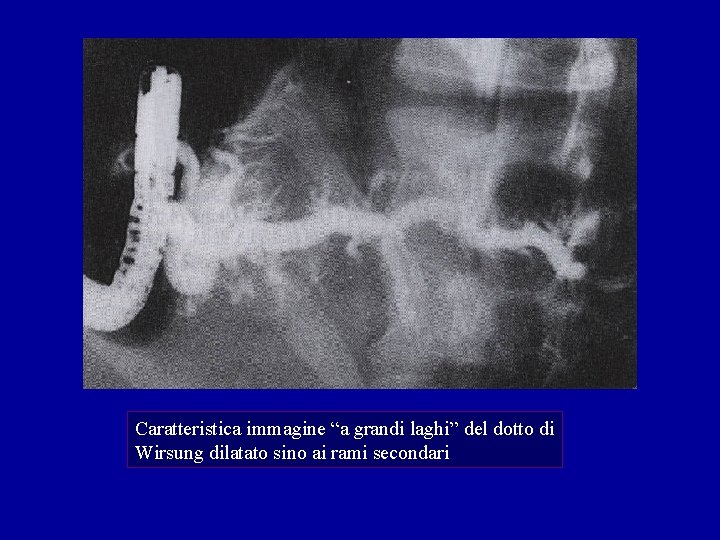 Caratteristica immagine “a grandi laghi” del dotto di Wirsung dilatato sino ai rami secondari Caratteristica immagine “a grandi laghi” del dotto di Wirsung dilatato sino ai rami secondari