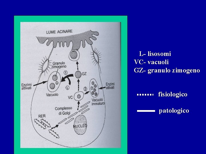 L- lisosomi VC- vacuoli GZ- granulo zimogeno fisiologico patologico L- lisosomi VC- vacuoli GZ- granulo zimogeno fisiologico patologico