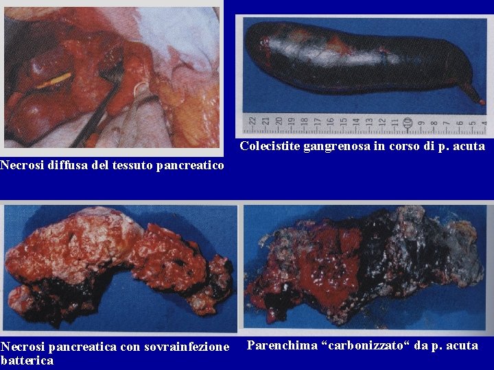 Colecistite gangrenosa in corso di p. acuta Necrosi diffusa del tessuto pancreatico Necrosi pancreatica Colecistite gangrenosa in corso di p. acuta Necrosi diffusa del tessuto pancreatico Necrosi pancreatica