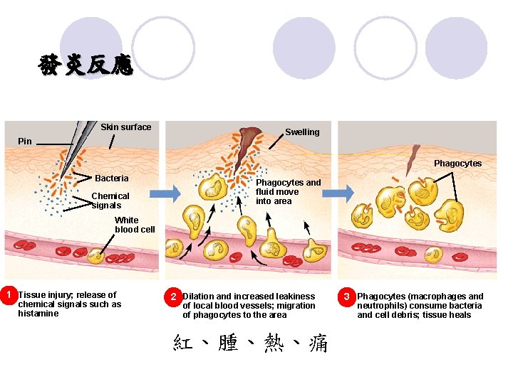 發炎反應 Skin surface Swelling Pin Phagocytes Bacteria Chemical signals Phagocytes and fluid move into