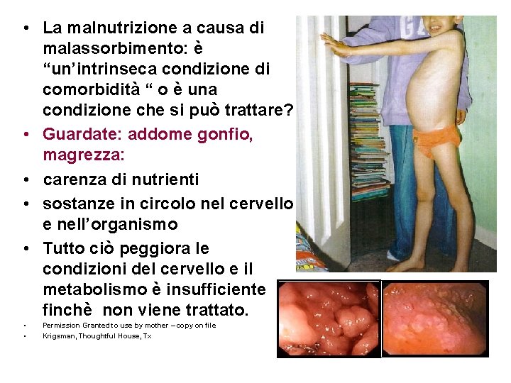  • La malnutrizione a causa di malassorbimento: è “un’intrinseca condizione di comorbidità “